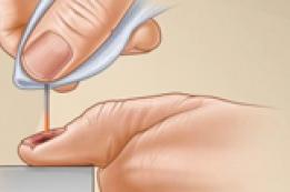 How to Drain Blood From Under a Nail